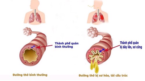 Bảo Phế Vương bán ở đâu? Ghi sổ ngay một số địa chỉ mua hàng uy tín